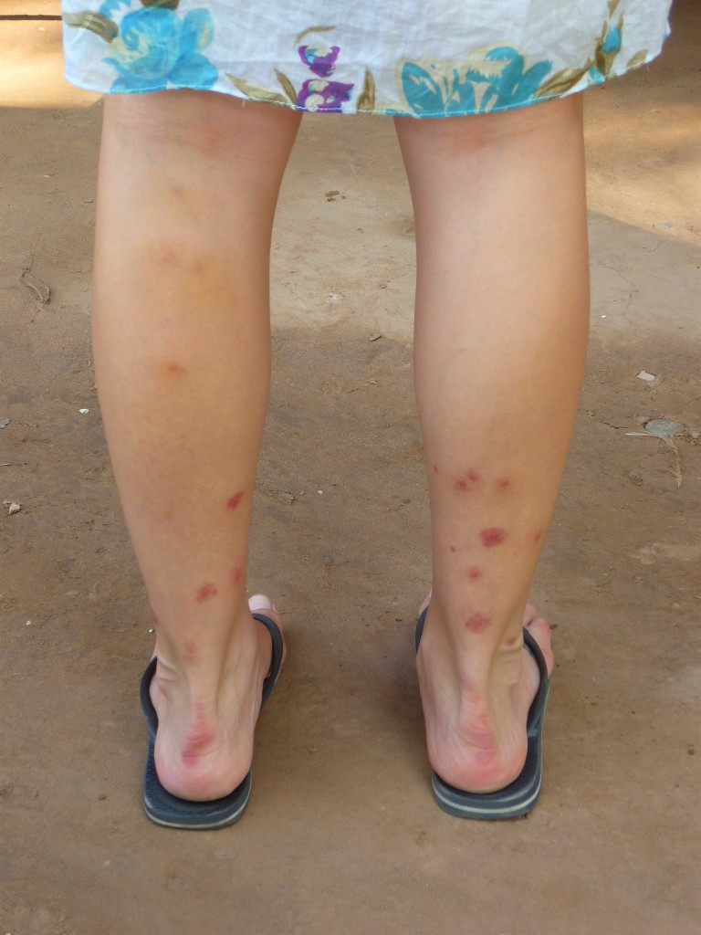 My poor insect bitten legs